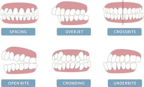 Braces Aurora CO | Straighten Crooked Teeth | Teeth Braces