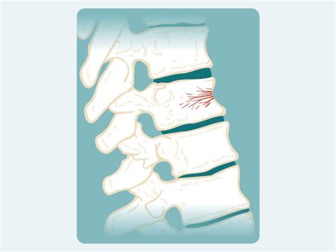 Vertebral Wedging: Symptoms, Diagnosis, and Treatment