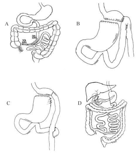 A . Jejunoileal bypass (Deitel, 1998). B . Original retrocolic gastric ...