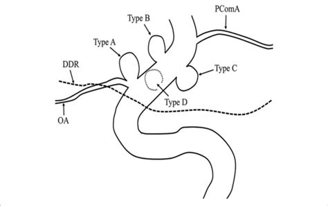 | Ophthalmic segment aneurysm classification. Aneurysms arising from ...