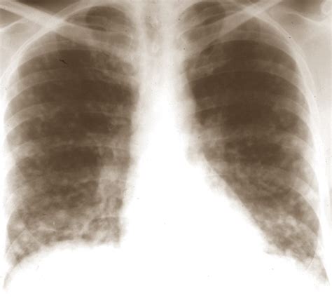 👉 Histoplasmosis - Symptoms, Treatment, Pictures, Causes (January 2022)