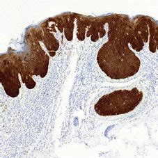 Koilocyte-like change in the superficial part of dysplastic epithelium,... | Download Scientific ...