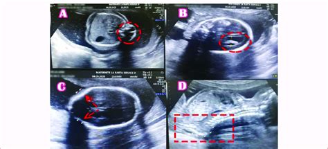 A-1D: Ultrasound showing fetal spina bifida. | Download Scientific Diagram