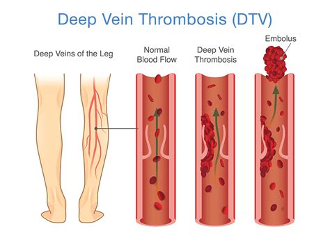 Lower Limb Deep Vein Thrombosis — Camperdown Vascular Laboratory - State of the Art Technology ...