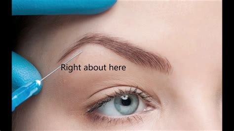 9+ botox brow lift botox injection sites diagram - SidneyShervin