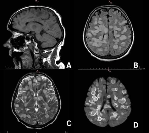 Patient P., MRI of the brain on the 8th day from the clinical... | Download Scientific Diagram