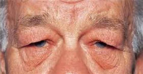 Dermatochalasis & Blepharoplasty | South Texas Eye Institute