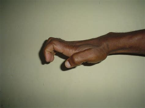 Ape hand deformity