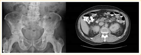 Bilateral Perinephric Stranding and Diffuse Bone Lesions - The American Journal of the Medical ...