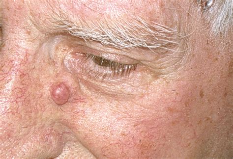 Adjacent Dermal Nodules on the Nose—Case | Dermatology | JAMA ...