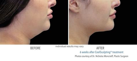 CoolSculpting Chin and Neck Fat | Best Double Chin Reduction