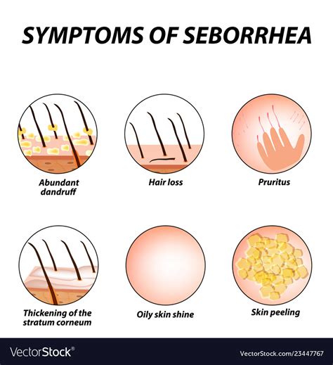 Symptoms of seborrhea seborrhea skin and hair Vector Image