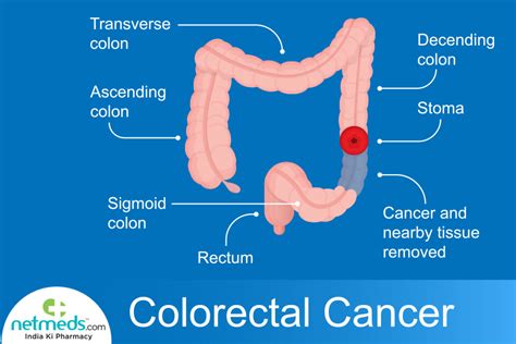 Rectal Cancer: Causes, Symptoms And Treatment | Netmeds