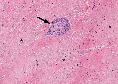 Odontogenic Myxoma Histology