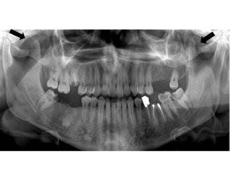 coronoid process Quiz