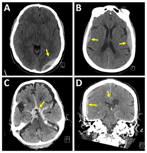 Medical Sciences | Free Full-Text | Neuroimaging of Traumatic Brain Injury