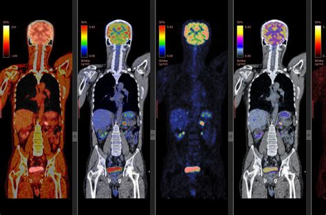 Premier Radiology Tennessee | PET/CT