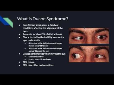 Duane Syndrome - YouTube