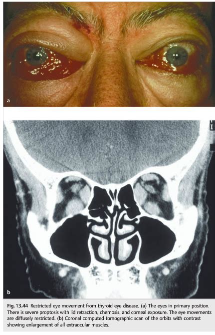 Questions of the Week: Diplopia 3 Diagnosis of Binocular Diplopia 1 — Neuro-Ophthalmology