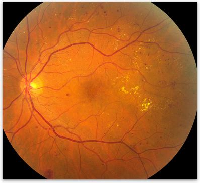 Diabetic Retinopathy - Retina-Vitreous Surgeons of CNY