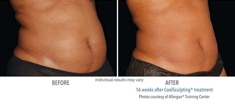 CoolSculpting before and after results from real patients - SCULPTDTLA.COM