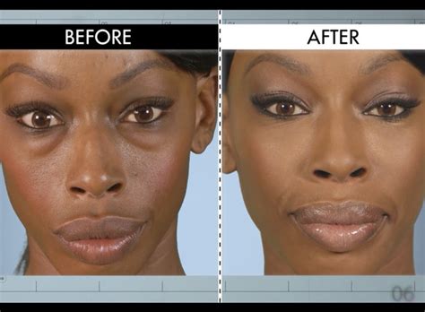 Puffy Eyes from Botched Patients Before and After—Shocking Transformations!