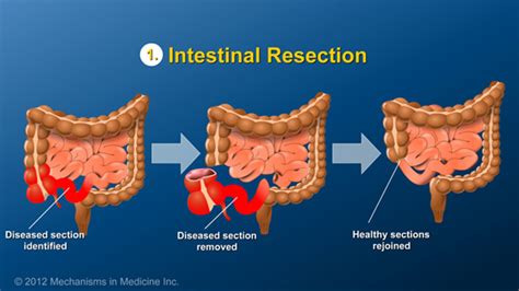 Slide Show - Small Bowel and Large Bowel Surgery for IBD