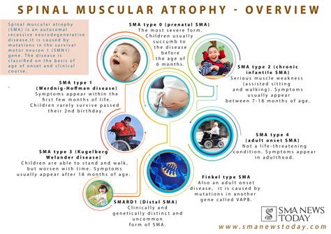 A Look At the Different Types of SMA - SMA News Today