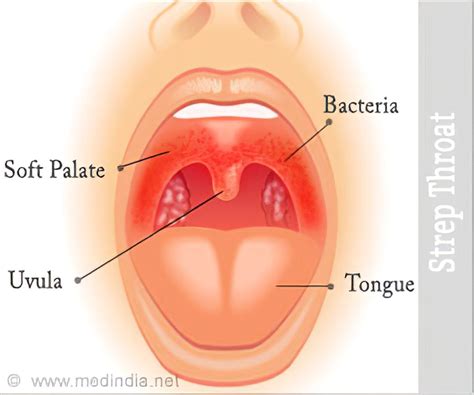 Strep Throat Blisters