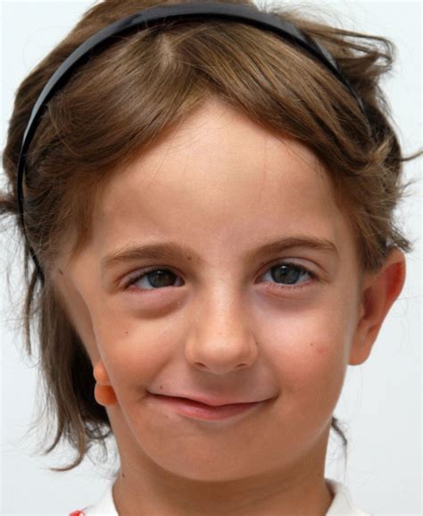 Goldenhar Syndrome | Hellenic Craniofacial Center