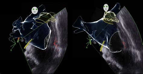 Left Atrial Appendage Occlusion with Intracardiac Echocardiography and Electroanatomic Mapping ...