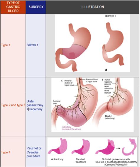 Gastric Ulcer Types