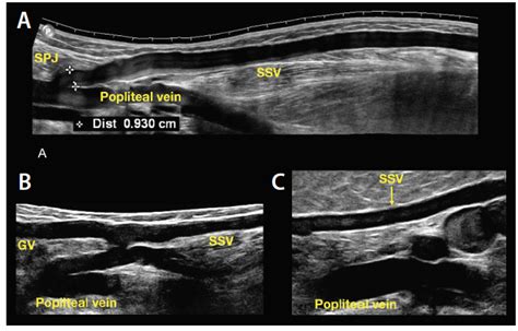 Duplex Ultrasound Technical Considerations for Lower Extremity Venous Disease - Endovascular Today