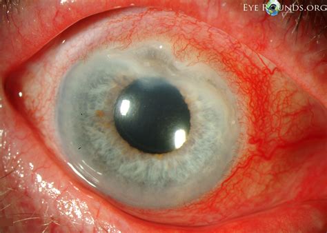 Peripheral Ulcerative Keratitis (PUK)