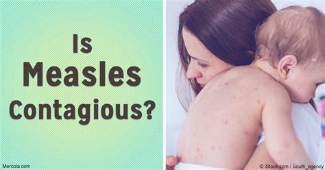 Is Measles Highly Contagious?