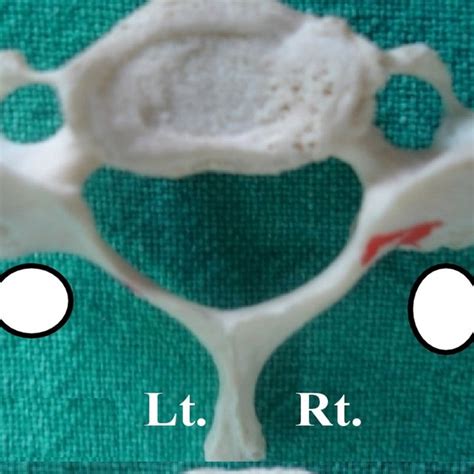 Showing bilateral Accessory Foramen Transversarium (AFT) & incomplete ...