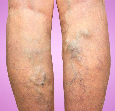 Varicose Veins Treatment - The Art of Vein Care