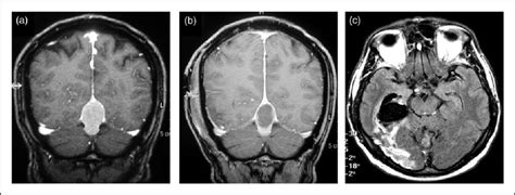 MRI demonstrating meningioma at the apex of the tentorial incisura: (a)... | Download Scientific ...