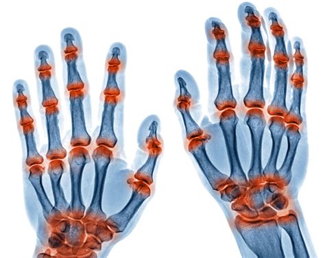 Hand Surgery to Treat Arthritis | Alexander Orthopaedic Associates