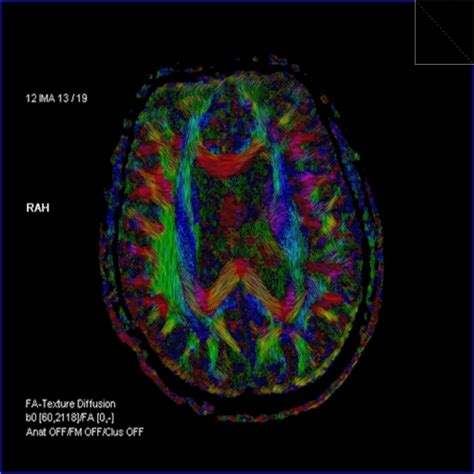 DTI Tractography - Siemens Healthineers Croatia