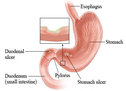 Duodenal Cancer Treatment | Modern Cancer Hospital Guangzhou, China