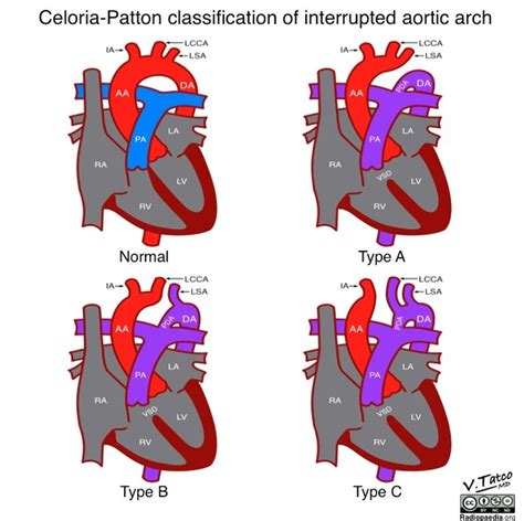 Interrupted aortic arch | Radiology Reference Article | Radiopaedia.org ...