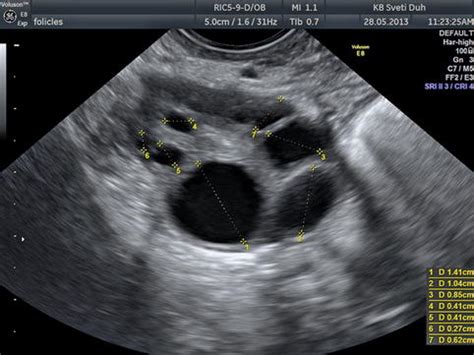 The Normal Ovary (Changes in the Menstrual Cycle) | Radiology Key