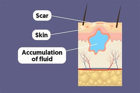 What Is a Seroma: Symptoms, Causes & Treatment - Tua Saúde