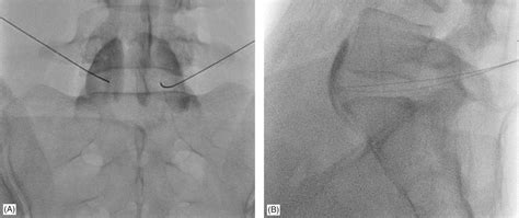 Superior and Inferior Hypogastric Plexus Blocks | Anesthesia Key