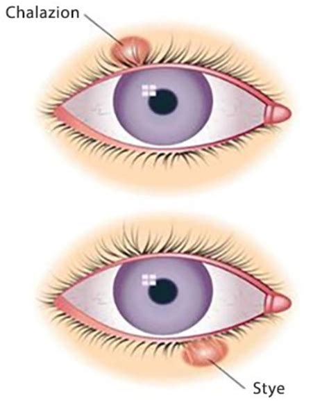 What Is the Difference Between a Chalazion and a Stye - HubPages