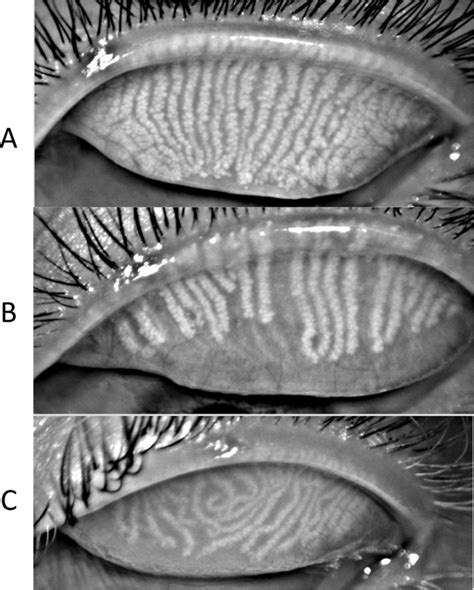 Meibomian-gland-characteristics-A-Typical-Meibomian-gland-orientation-with-glands - Eyestyle