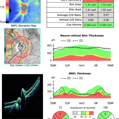 Correlation between inter-eye asymmetry of the RNFL thickness and... | Download Scientific Diagram