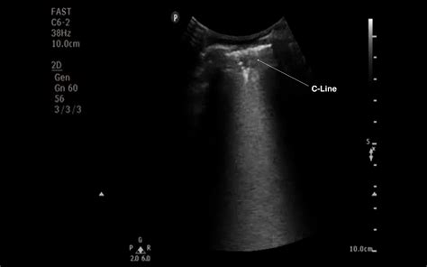 Ultrasound Diagnosis of Pneumonia | Emory School of Medicine