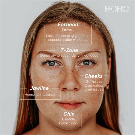 What Kind Of Acne Are You Dealing With? - Boho Alternative Medical Spa